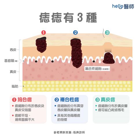 痣上的毛|痣形成的原因？痣長毛、痣變多變大是痣病變？5招判。